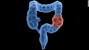 Colorectal cancer (colon cancer) is the cause of many cancer deaths. Colorectal Cancer Us Task Force Lowers Recommended Age To Start Cancer Screening To 45 Cnn