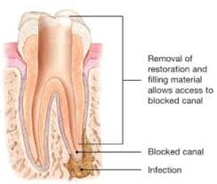 Bacteria have developed defense mechanisms that help them. Endodontic Retreatment Explained American Association Of Endodontists