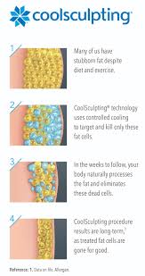 10 отметок «нравится», 0 комментариев — avalon medical spa (@avalonmedicalspa) в instagram: Coolsculpting External Page 2020