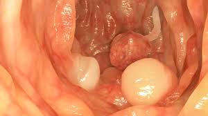 A hyperplastic polyp is a growth of extra cells that projects out from tissues inside your body. Colonic Polyps Types Causes Treatment And More