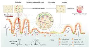 Image result for Neutropenic Colitis