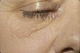 Xanthelasma or xanthomas tca treatment is very similar to xanthelasma treated with electrolysis. Xanthomas Plane Planar Xanthoma Palmar Xanthoma Intertriginous Xanthoma Diffuse Xanthoma Xanthelasma Dermatology Advisor