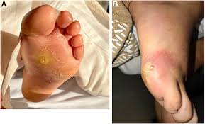 Image result for IDSA Diabetic Foot Wound Classification