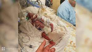 However, a baby born at 25 weeks is still extremely premature. Survival At Just 25 Weeks Unitypoint Health