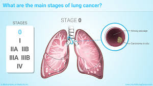Stage ii cancer refers to larger tumors or cancers that have grown more deeply into nearby tissue. Slide Show Staging Of Lung Cancer