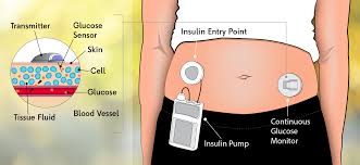 Continuous Glucose Monitoring The Ultimate Guide To Cgms