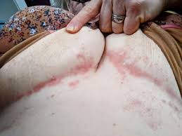 Image result for Candidiasis under breasts