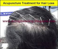 Alopecia areata occurs when your. Tcm News Tcm Treatment For Hair Loss Alopecia Areata And Dandruff