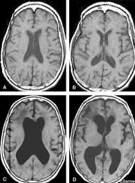 Image result for Normal Pressure Hydrocephalus