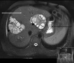 Mar 31, 2021 · the right upper quadrant (ruq) is a section of your tummy (abdomen). A Farmer With Fever And Right Upper Quadrant Pain The Bmj
