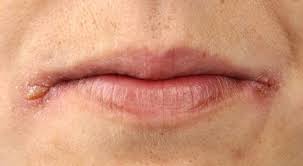 заеды в уголках рта причины и лечение у взрослых Zaedy V Ugolkah Rta Prichiny I Lechenie