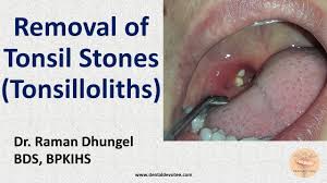 Image result for Tonsillolith
