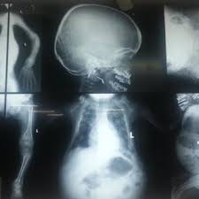 Pdf Radiographic Imaging Of Metabolic Bone Disorders And Their Relative Management