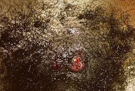 Another condition that's normal and no cause for concern is pearly penile papules. Skin Problems Skin Conditions Below The Waist