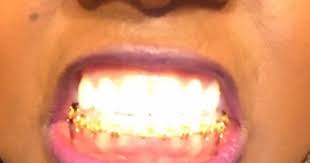 Gold Braces Show Me Your Teeth Gold Braces Cute Braces Colors Braces Colors