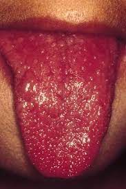 Recurrent Kawasaki Disease British Dental Journal