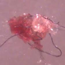 Saveli vr, leitao mm, stricker rb. What Is Morgellons Disease Is It A Physical Or Psychological Condition Scientific American