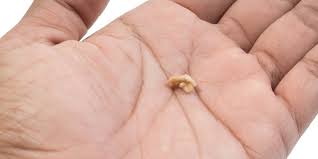 Image result for Tonsillolith