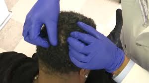 Hair transplant, or restoration surgery, can make the most of the hair you have left. Can Fibroids Cause Hair Loss Aglow Dermatology
