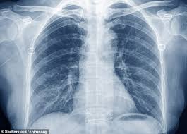 Image result for lung cancer xray