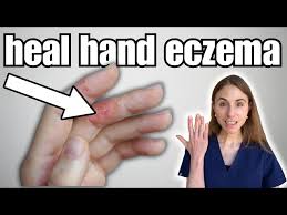 Image result for Hand Dermatitis