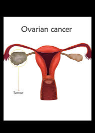 Seven symptoms were found associated with ovarian cancer, including: Ovarian Cancer Africa Cancer Hub