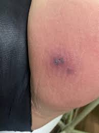 Image result for spinne biss haut reaktion