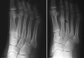 Stress fractures develop quickly and are not caused by anyone specific injury. Stress Fractures Of The Foot And Ankle Orthoinfo Aaos