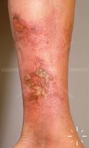 Image result for erysipel photos)