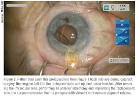If you are having more difficulties with night vision, or with reading small words on your television how do i know if i need cataract surgery? Back To Basics Complicated Cataracts