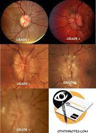 Twitter Retinal Photography Optometry Eye Anatomy