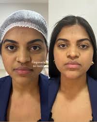 O nariz com a ponta para baixo era o incômodo dessa paciente , em alguns  minutos seu problema foi resolvido 🥰