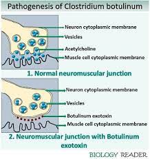 Paralysis the wound may or may not appear red and swollen. What Is Clostridium Botulinum Definition Morphology Exotoxin Biology Reader