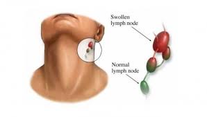 I was treated with an antibiotic, but could someone recommend what i can put on my scalp to alleviate the. Swollen Lymph Nodes Can Be Cured Naturally Industry Global News24