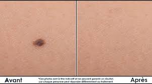 Une al zou couic plus rien une suture ou un strip et tu t'en va. Traitements Des Grains De Beaute Clinique Infinium Hull Gatineau Ottawa