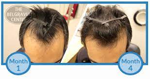 Sold as a topical liquid solution, a foam and a spray, minoxidil (also known as the brand rogaine) is the most popular topical hair loss medication on the market. Why Am I Losing More Hair After Just Starting Minoxidil