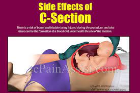 Side Effects Of C Section Vs Natural Birth