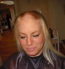 With each type of hair loss, the exact link between the hair loss and stress is somewhat unclear. Stress Heartbreak And Hair Loss In Women