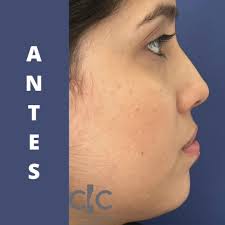 Rinoplastia donde se armonizó el rostro con solo proyectar la punta nasal  sin rotación., Agenda tu consulta!