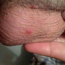 Granos Rojos Que Me Pican En Escroto Y Pene Dermatologo Net