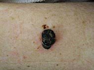 When cancerous tumors form on connective tissues, it is a sarcoma. Melanoma Wikipedia