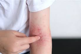 Image result for Atopic Dermatitis