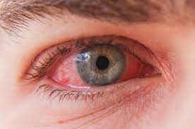 It was first identified in december 2019 in wuhan,. Can You Contract Coronavirus Through Your Eyes