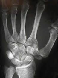 Image result for Trapezoid Bone