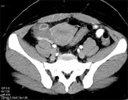 This type of functional ovarian cyst occurs after an egg has been released from a follicle. Corpus Luteum Cyst Ob Gyn Case Studies Ctisus Ct Scanning