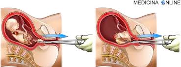 Il test di gravidanza valuta la concentrazione dell'ormone beta hcg all'interno delle urine o del sangue. Raschiamento E Doloroso Quando Avere Rapporti Perdite E Nuova Gravidanza Medicina Online