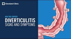 Image result for Diverticulitis