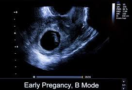 Experiencing a miscarriage for any reason is painful. Gestational Sac During Pregnancy