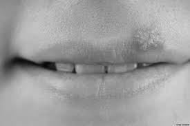 Have people with herpes been able to resolve it later in life? Herpes Simplex Virus Hsv Overview Symptoms And Treatment