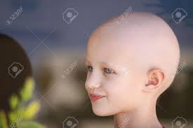 Should one use a wig after hair loss due to chemotherapy? Portrait Of A Caucasian Child Suffering Hair Loss Due To Chemotherapy Stock Photo Picture And Royalty Free Image Image 9590125